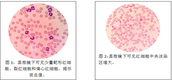 偏心红细胞图片图片